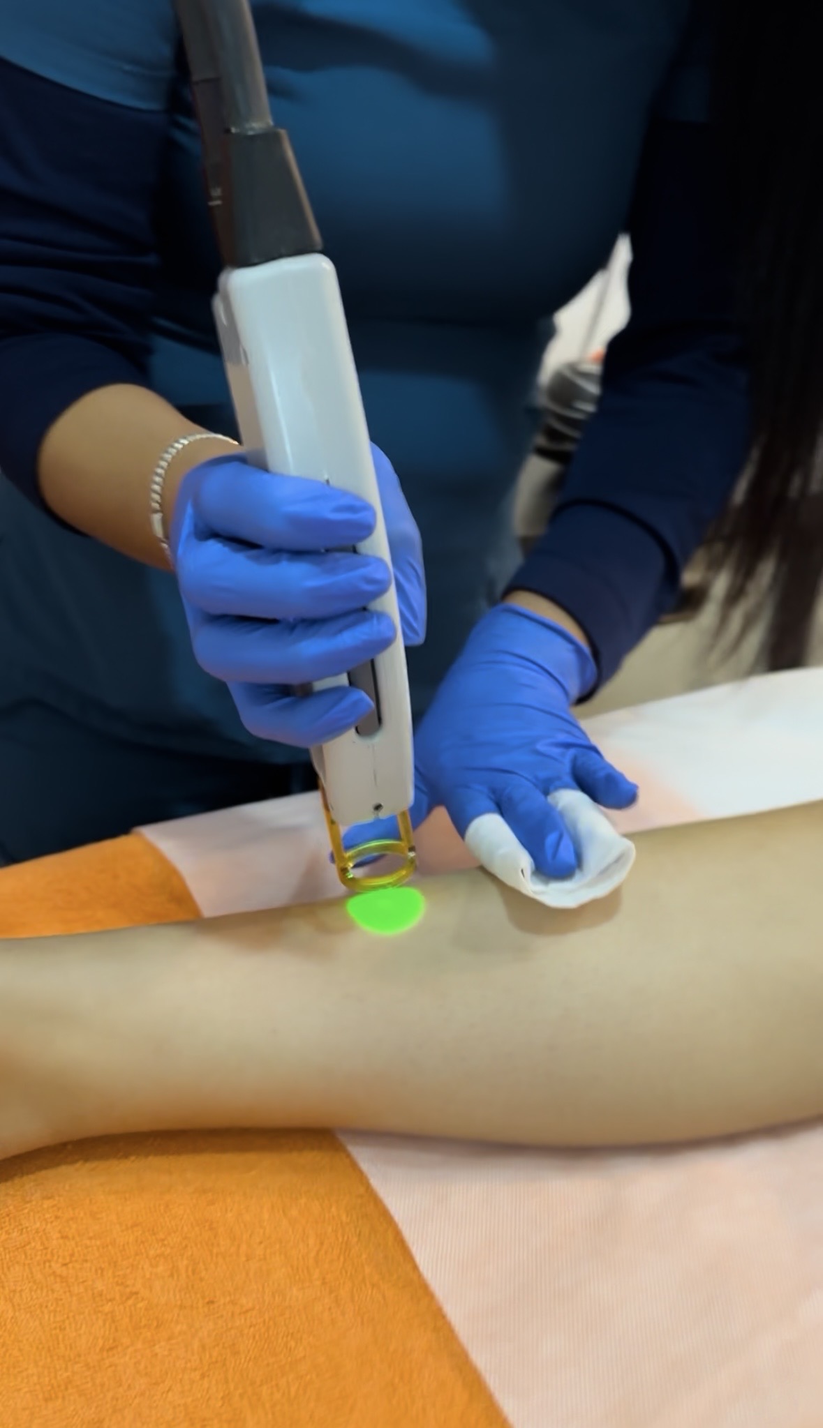 Sesión de depilación láser en curso con el equipo Candela